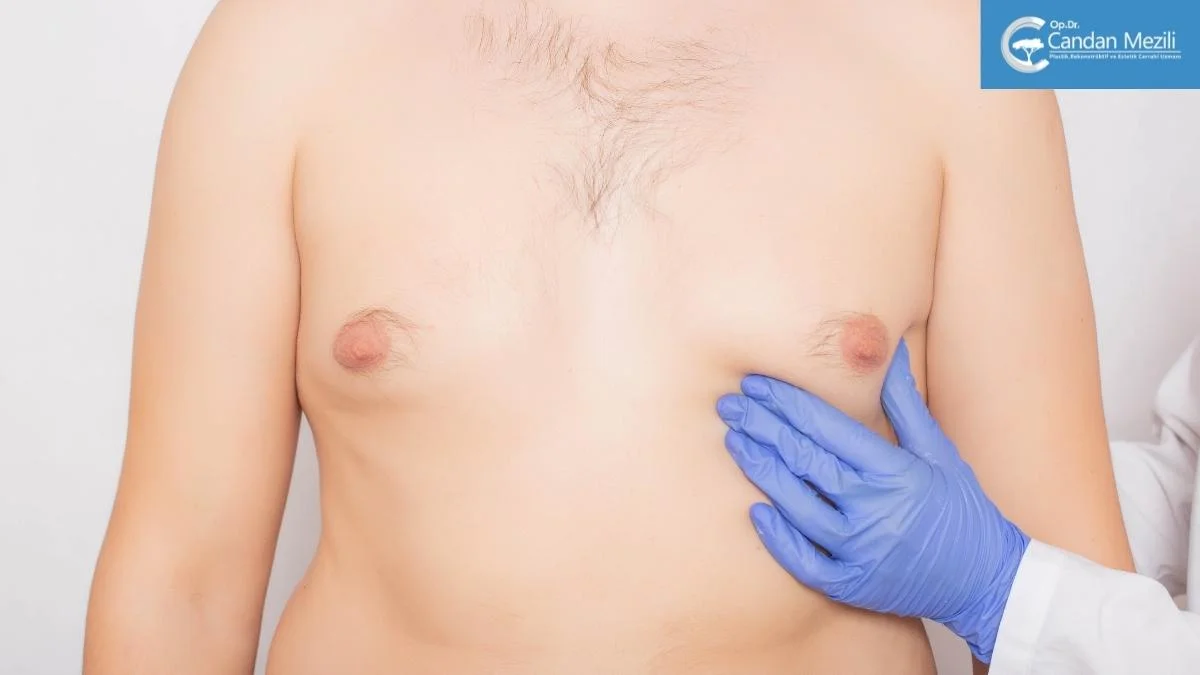 Gynecomastia Surgery in Turkey Gynecomastia Surgery in Turkey