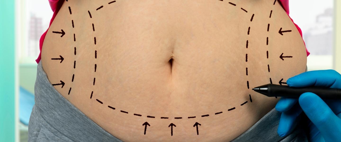 How Much Does Liposuction Surgery Cost?