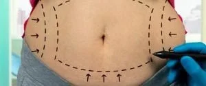 Liposuction Fiyatları Liposuction Fiyatları 2022