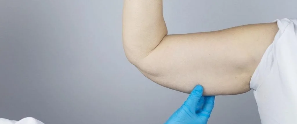 How Much Does Arm Lift Cost in UK? How Much Does Arm Lift Cost?