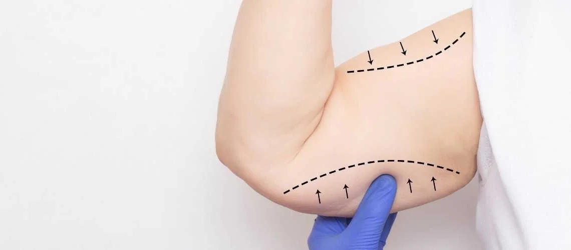 How Much Does Arm Lift Cost in UK? How Much Does Arm Lift Cost in UK?