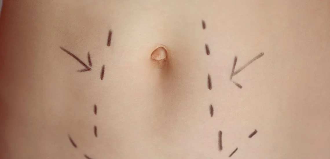 Liposuction Fiyatları Liposuction Fiyatları