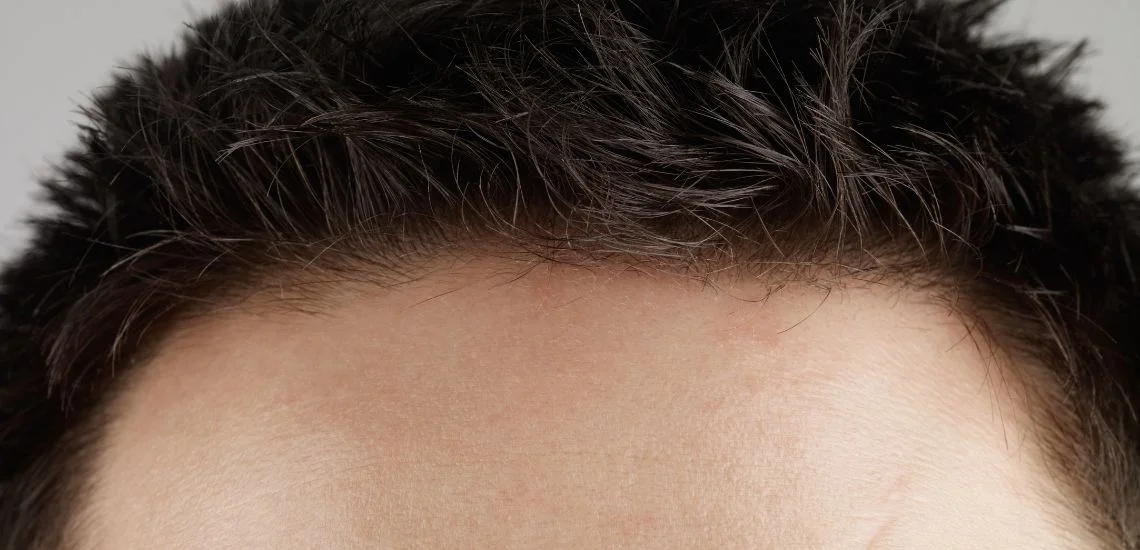 Alın Daraltma Ameliyatı Fiyatları  Alın Daraltma Ameliyatı Fiyatları