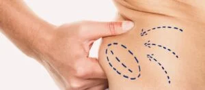 Vaser Liposuction Fiyatları Vaser Liposuction Fiyatları 2022