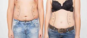 Liposuction surgery abroad (Fat Removal) Liposuction Operation in Abroad