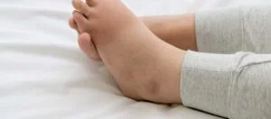 Lipödem Belirtileri ve Nedenleri Nelerdir? Lipödem Belirtileri ve Nedenleri Nelerdir?
