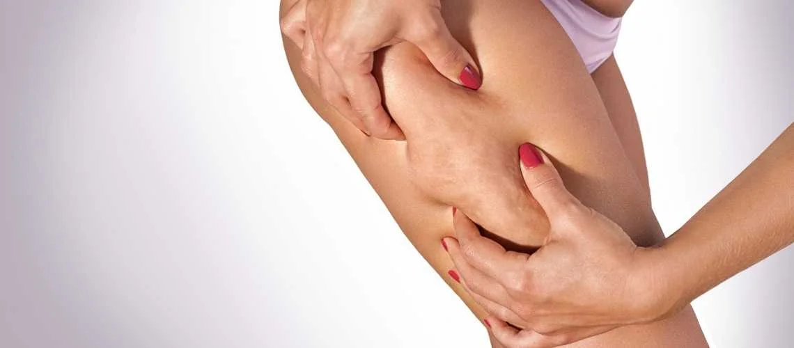Lipedema vs Cellulite: What Are the Differences? Lipedema vs Cellulite: What Are the Differences?