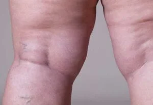 Lipödem in Izmir, Türkei