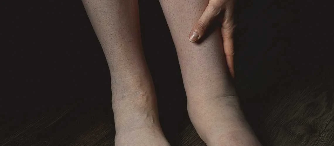 Lipödem OP in der Türkei Lipödem in Izmir, Türkei