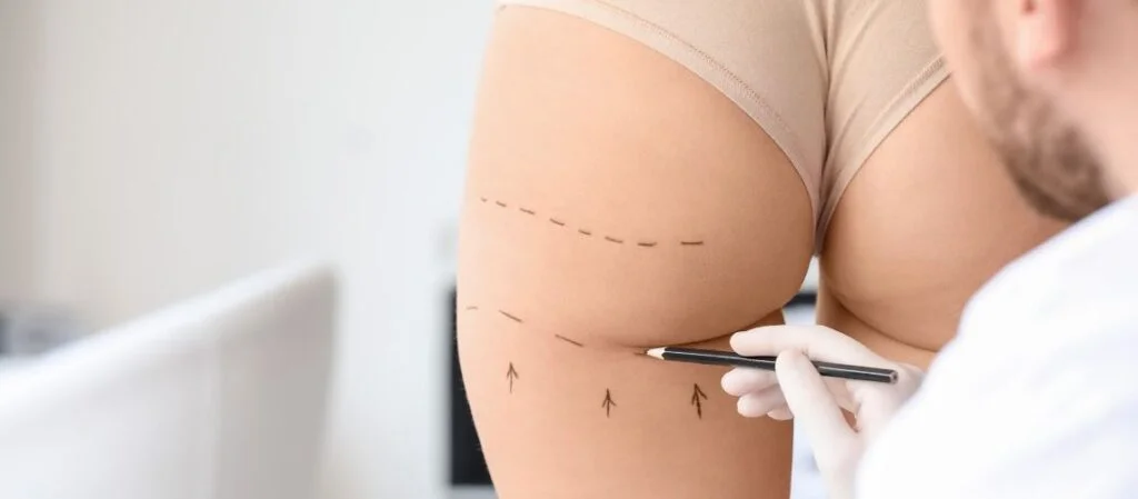 Buttocks Liposuction in Turkey Buttocks Liposuction in Turkey