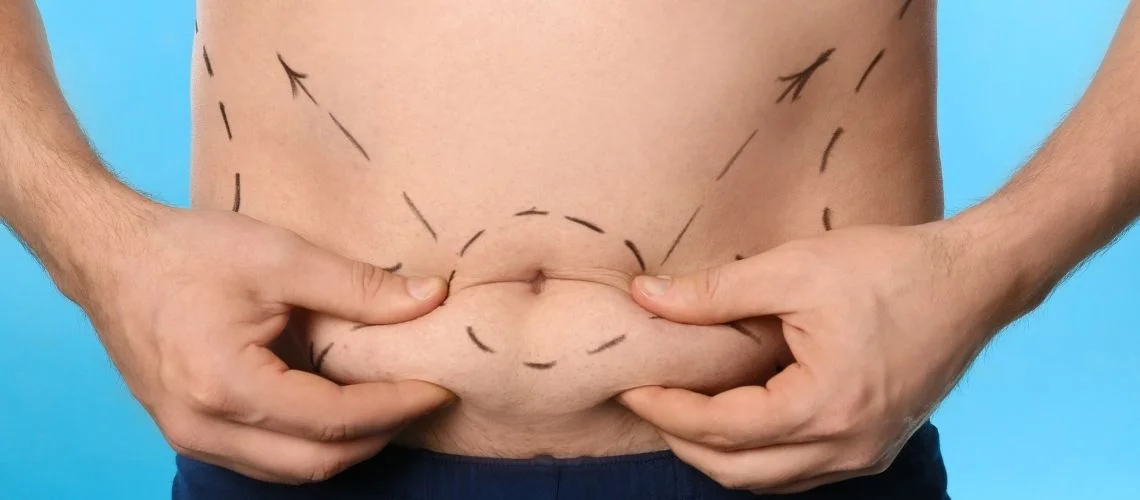 Back Liposuction in Turkey