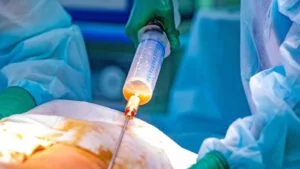 Lipödem-Behandlung mit Liposuktion Lipödem-Behandlung mit Liposuktion