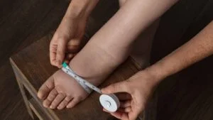 Unterschied zwischen Lipödem und Lymphödem Unterschied zwischen Lipödem und Lymphödem