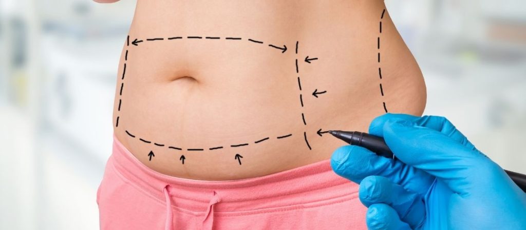 Liposuction Sonrası Nelere Dikkat Edilmeli? Liposuction Sonrası Nelere Dikkat Edilmeli?